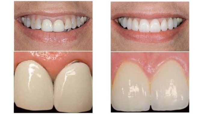 metalokeramicheskie-koronki-porivn